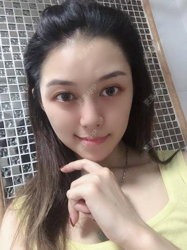 更美 - 贝勒爷贝贝的全脸整形套餐经验 | 全脸整形套餐 | V脸套餐 | 北京