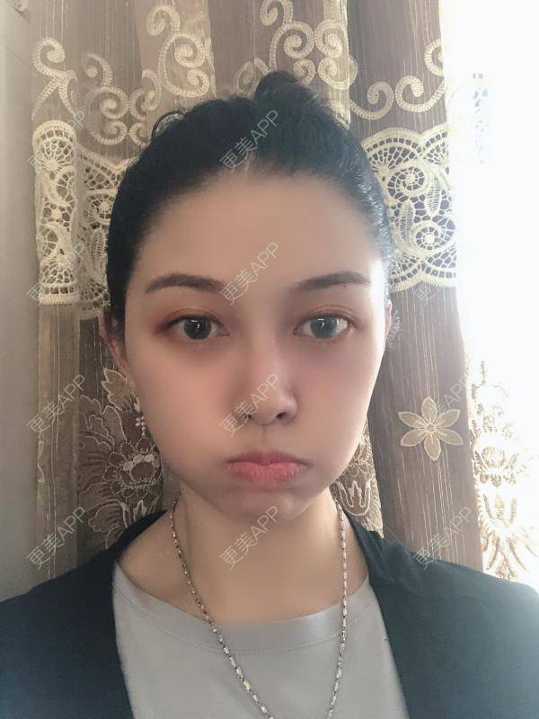 更美 - 贝勒爷贝贝的全脸整形套餐经验 | 全脸整形套餐 | V脸套餐 | 北京