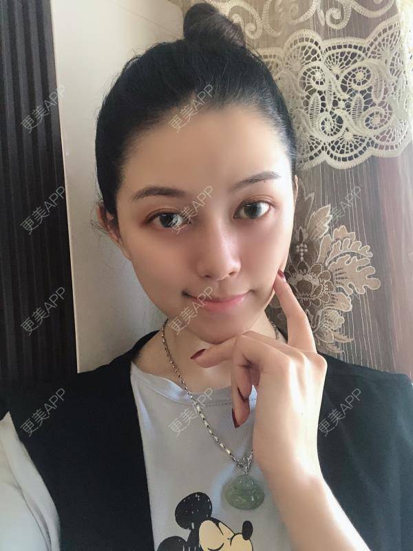 更美 - 贝勒爷贝贝的全脸整形套餐经验 | 全脸整形套餐 | V脸套餐 | 北京