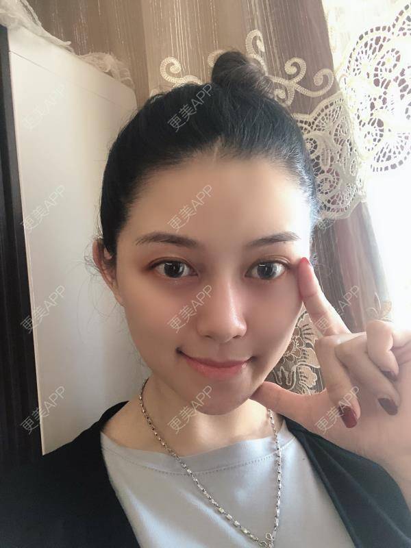 更美 - 贝勒爷贝贝的全脸整形套餐经验 | 全脸整形套餐 | V脸套餐 | 北京