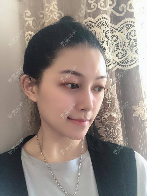 更美 - 贝勒爷贝贝的全脸整形套餐经验 | 全脸整形套餐 | V脸套餐 | 北京