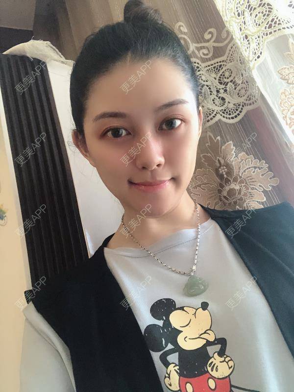 更美 - 贝勒爷贝贝的全脸整形套餐经验 | 全脸整形套餐 | V脸套餐 | 北京