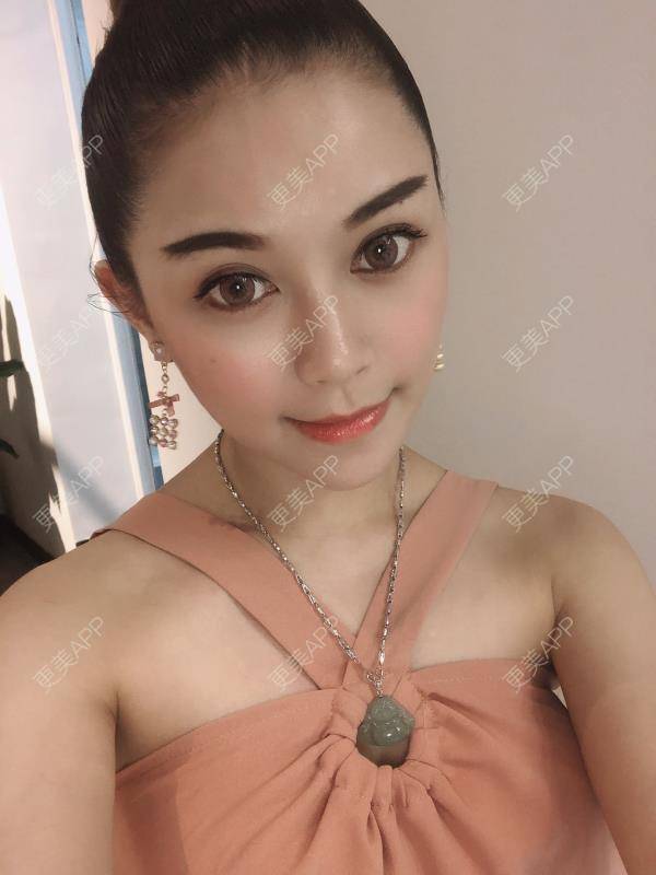 更美 - 贝勒爷贝贝的全脸整形套餐经验 | 全脸整形套餐 | V脸套餐 | 北京