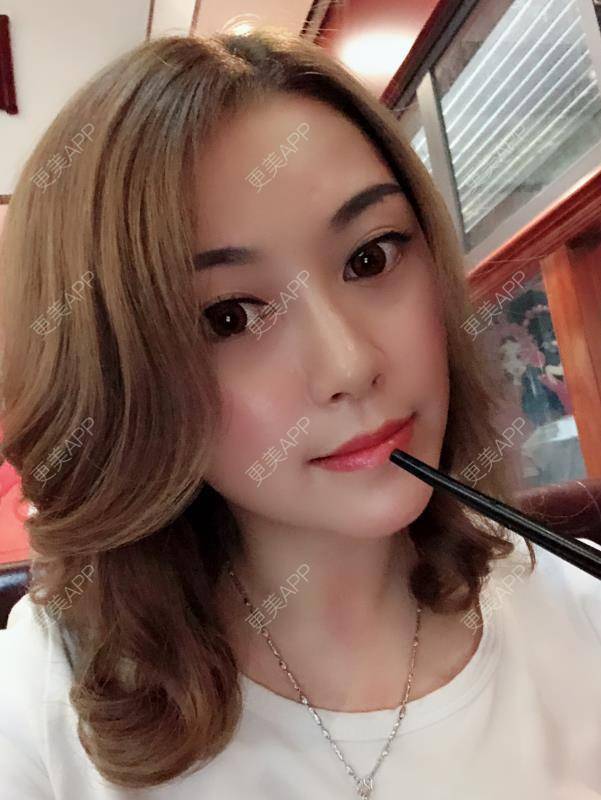 更美 - 贝勒爷贝贝的全脸整形套餐经验 | 全脸整形套餐 | V脸套餐 | 北京