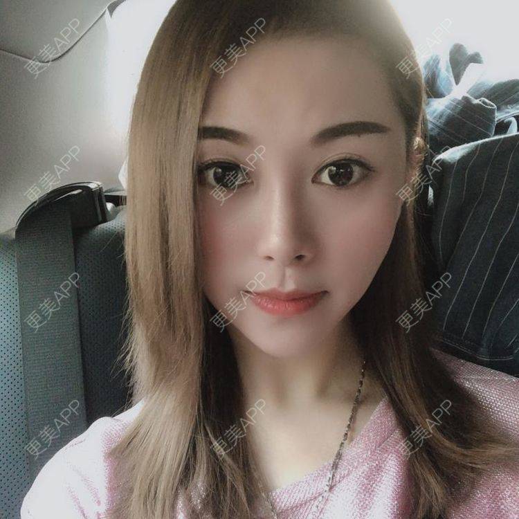 更美 - 贝勒爷贝贝的全脸整形套餐经验 | 全脸整形套餐 | V脸套餐 | 北京