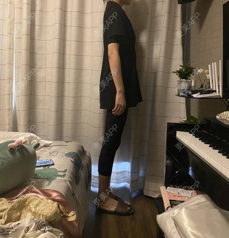 更美 - 玉琼#的自体脂肪丰臀经验 | 自体脂肪丰臀 | 上海 | 自体脂肪身体塑形