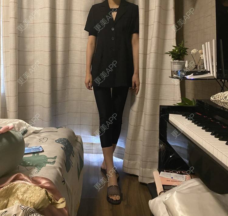 更美 - 玉琼#的自体脂肪丰臀经验 | 自体脂肪丰臀 | 上海 | 自体脂肪身体塑形