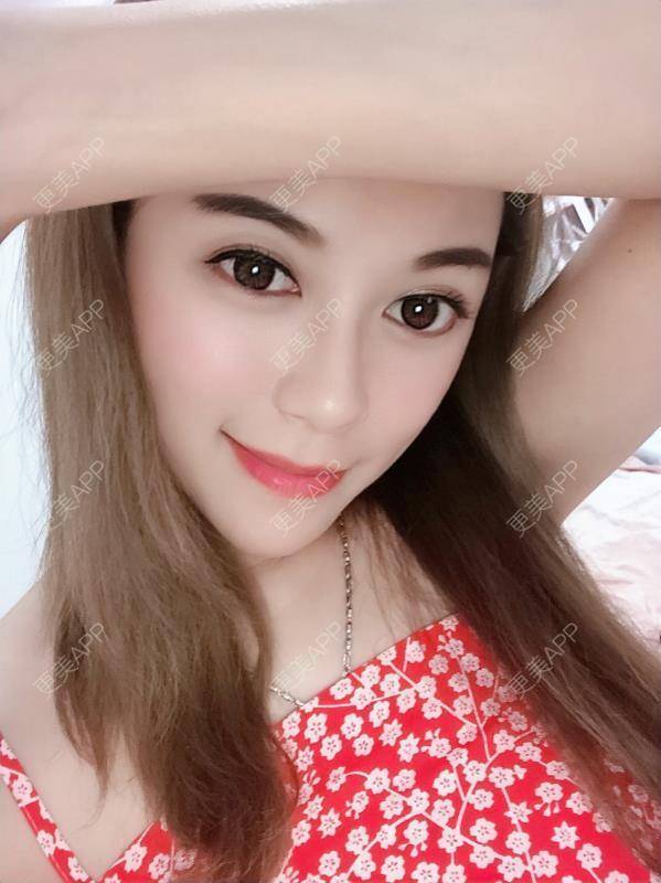 更美 - 贝勒爷贝贝的全脸整形套餐经验 | 全脸整形套餐 | V脸套餐 | 北京