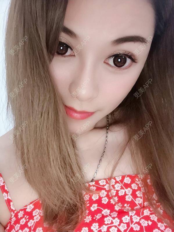 更美 - 贝勒爷贝贝的全脸整形套餐经验 | 全脸整形套餐 | V脸套餐 | 北京