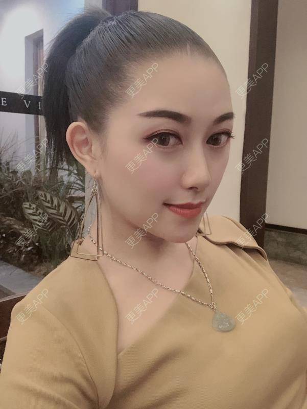 更美 - 贝勒爷贝贝的全脸整形套餐经验 | 全脸整形套餐 | V脸套餐 | 北京