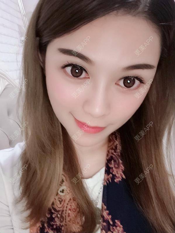 更美 - 贝勒爷贝贝的全脸整形套餐经验 | 全脸整形套餐 | V脸套餐 | 北京