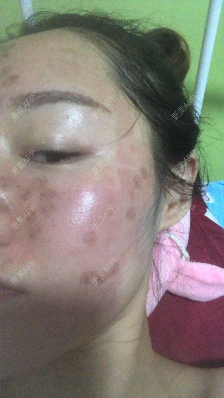 激光全脸部】痘坑修复 凹坑痘印/色素沉着/痘坑改善成都$1280起【点阵