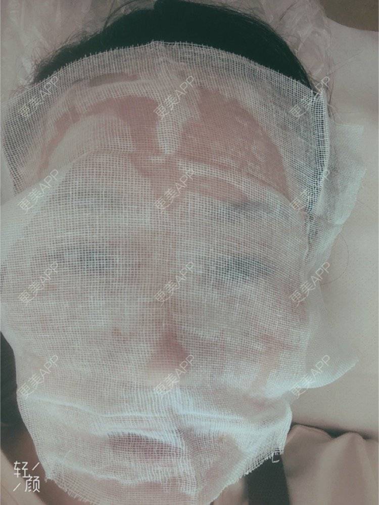 更美 - 更美用户KypVf5ovVE的点阵激光经验 | 上海 | 点阵激光