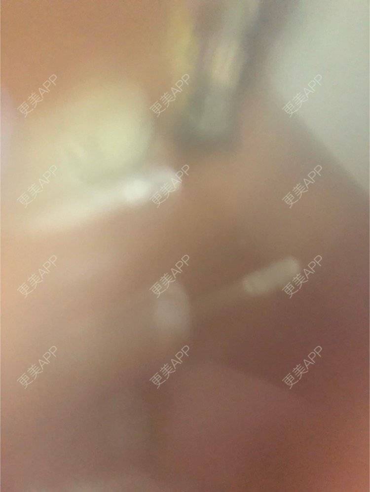 更美 - 更美用户KypVf5ovVE的点阵激光经验 | 上海 | 点阵激光