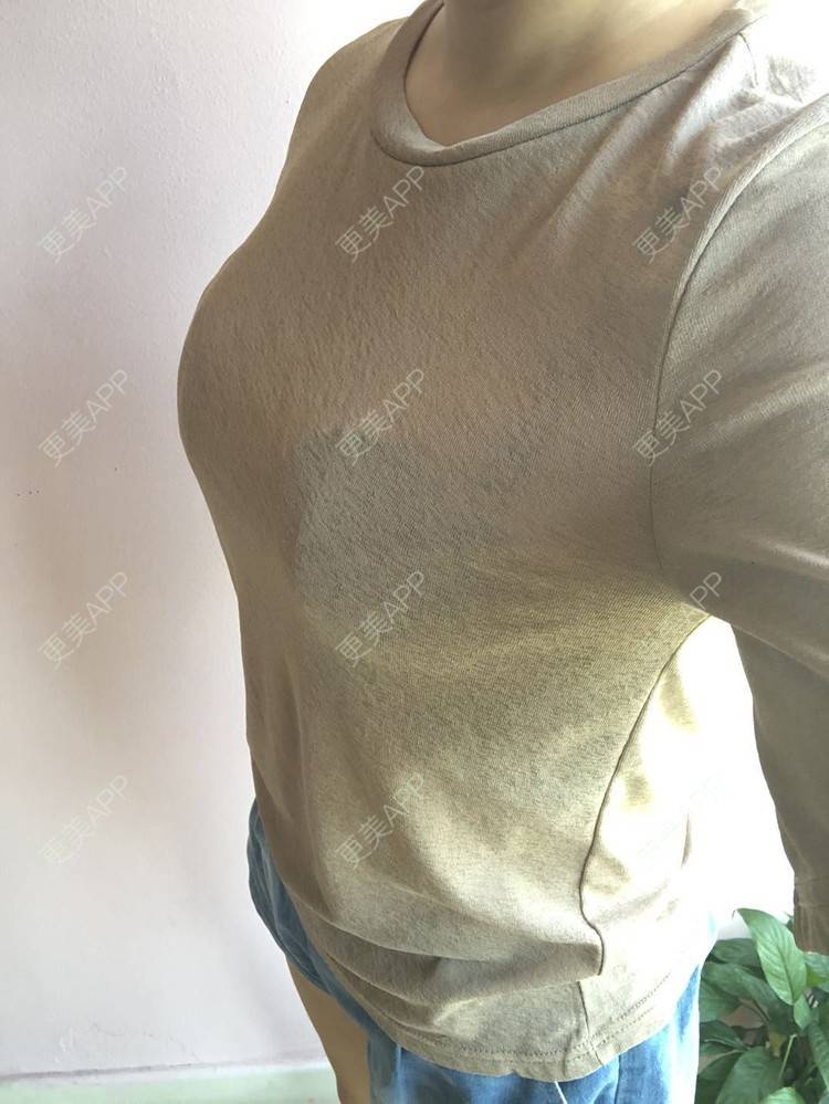 更美用户6v7mcwl8ke的假体隆胸日记