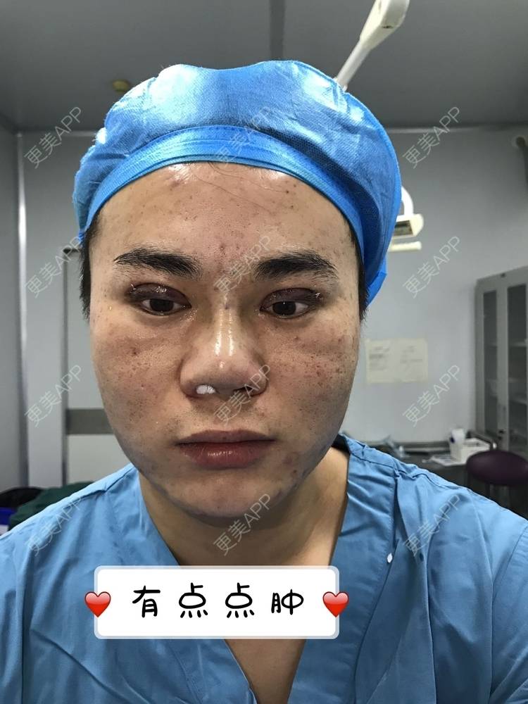 更美 - 更美用户icRJAuFJQH的膨体隆鼻经验 | 膨体隆鼻 | 郑州