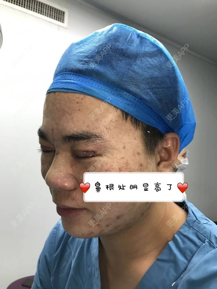 更美 - 更美用户icRJAuFJQH的膨体隆鼻经验 | 膨体隆鼻 | 郑州