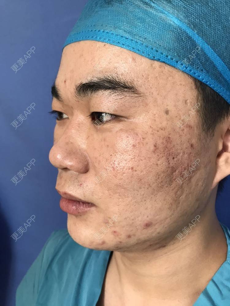 更美 - 更美用户icRJAuFJQH的膨体隆鼻经验 | 膨体隆鼻 | 郑州