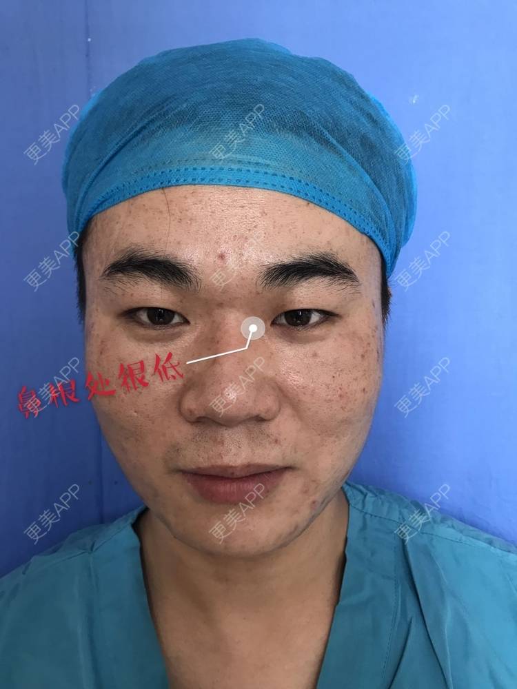 更美 - 更美用户icRJAuFJQH的膨体隆鼻经验 | 膨体隆鼻 | 郑州