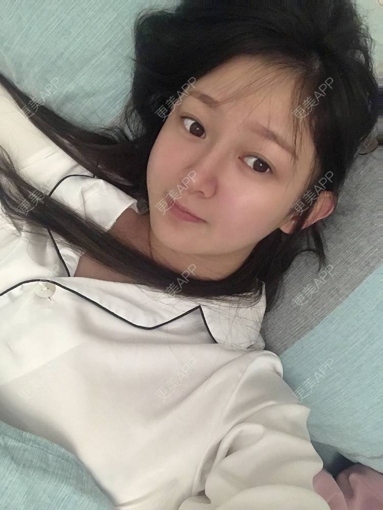 更美 - 轻鸿一撇一捺的鼻部多项经验 | 肋软骨隆鼻 | 手术缩鼻头 | 自体软骨垫鼻尖 | 鼻部多项 | 注射缩鼻头