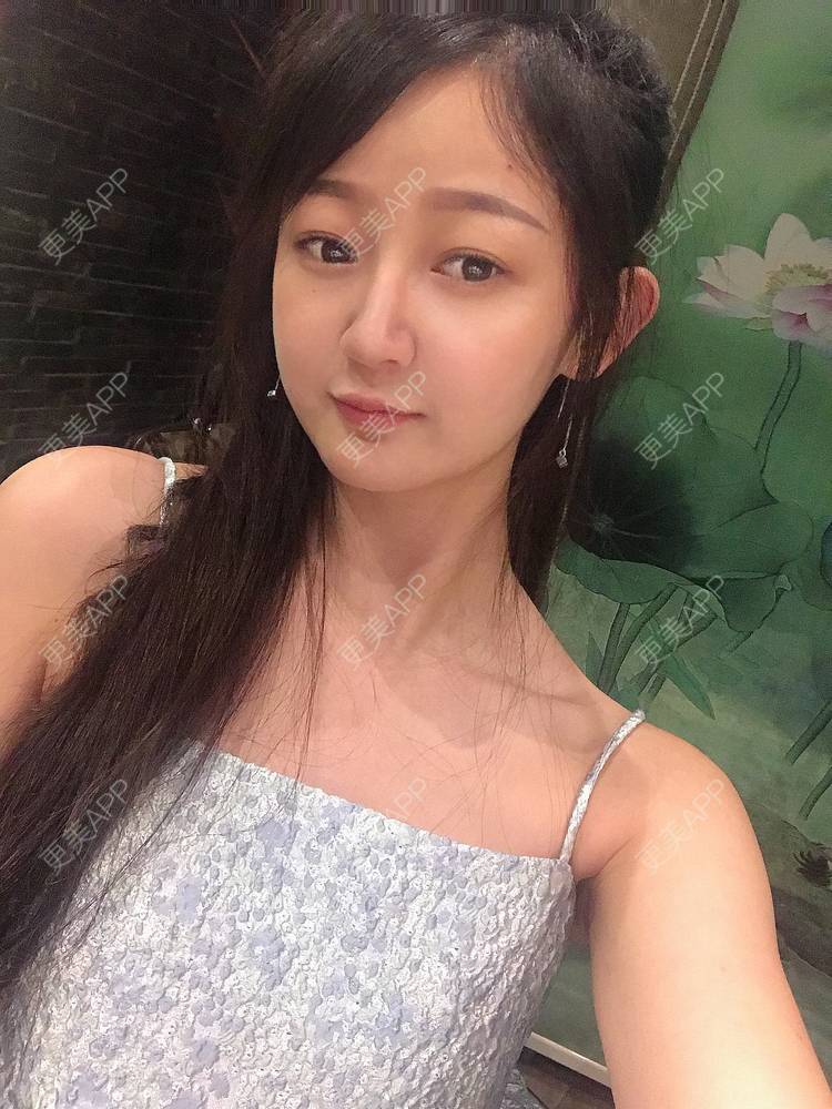 更美 - 轻鸿一撇一捺的鼻部多项经验 | 肋软骨隆鼻 | 手术缩鼻头 | 自体软骨垫鼻尖 | 鼻部多项 | 注射缩鼻头