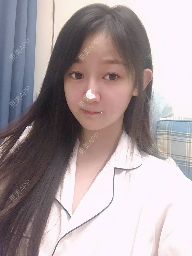 更美 - 轻鸿一撇一捺的鼻部多项经验 | 肋软骨隆鼻 | 手术缩鼻头 | 自体软骨垫鼻尖 | 鼻部多项 | 注射缩鼻头