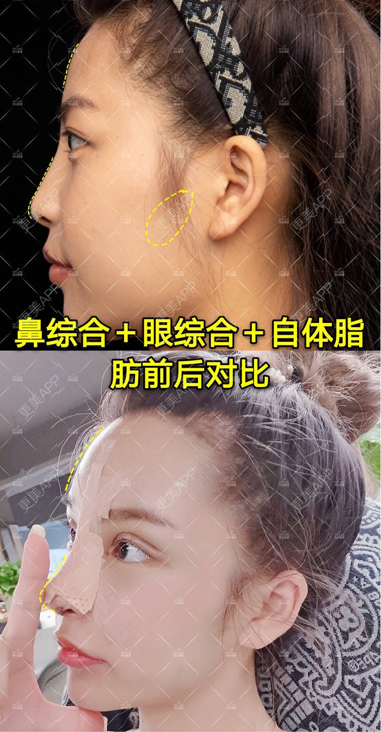 更美 - 土豆泥泥泥的双眼皮经验 | 自体脂肪面部填充 | 眼部多项 | 鼻部多项 | 苏州 | 隆鼻 | 双眼皮