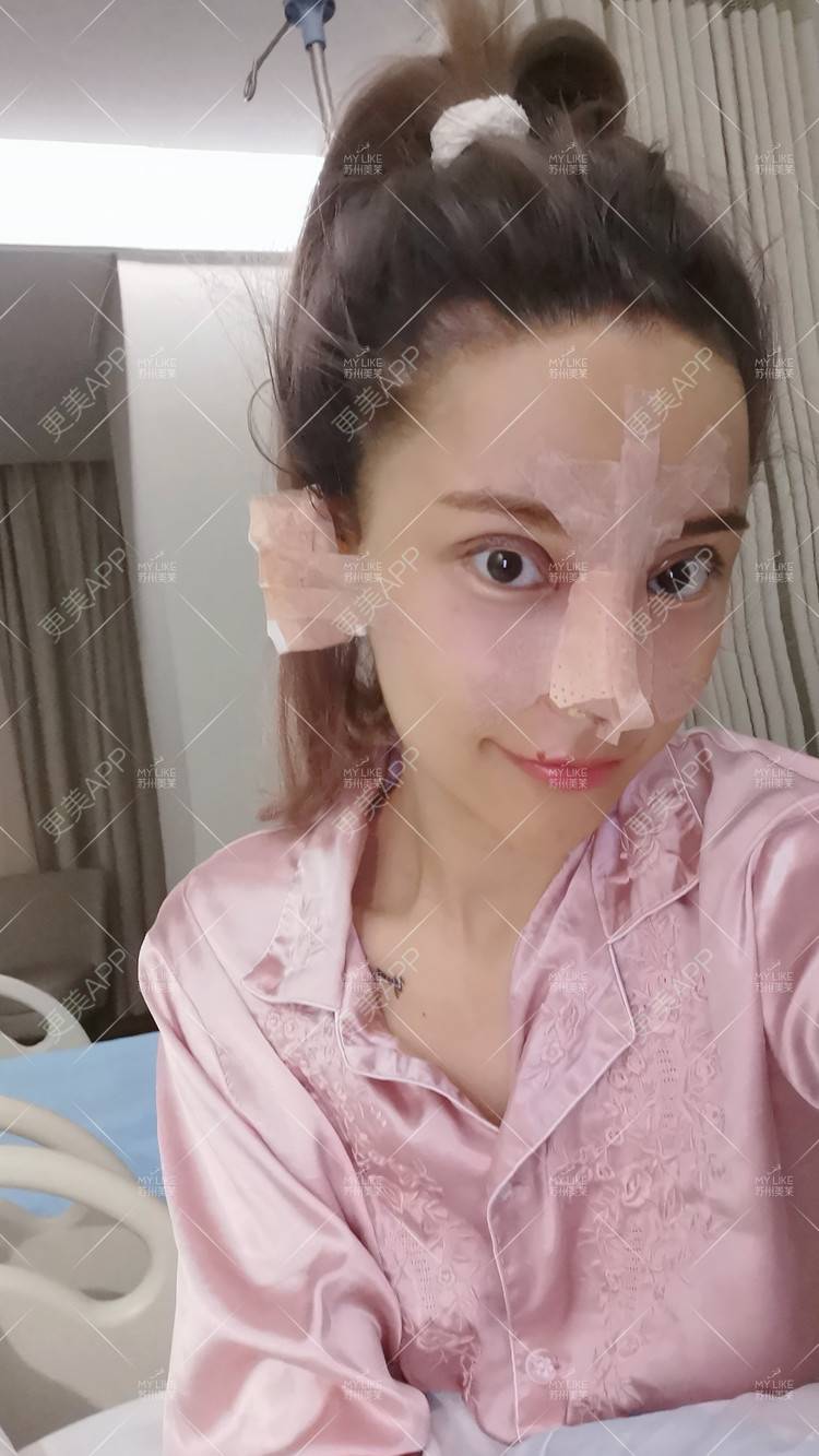更美 - 土豆泥泥泥的双眼皮经验 | 自体脂肪面部填充 | 眼部多项 | 鼻部多项 | 苏州 | 隆鼻 | 双眼皮