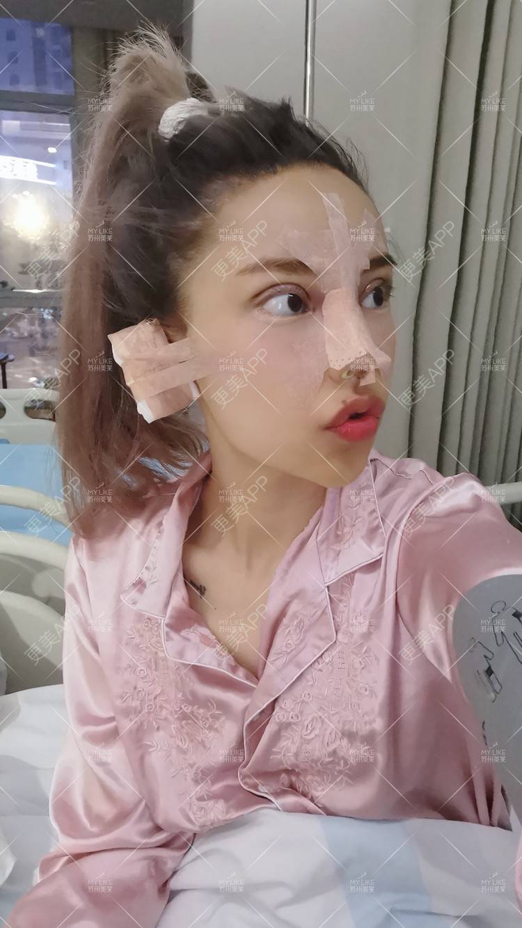 更美 - 土豆泥泥泥的双眼皮经验 | 自体脂肪面部填充 | 眼部多项 | 鼻部多项 | 苏州 | 隆鼻 | 双眼皮