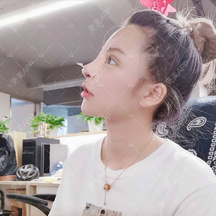 更美 - 土豆泥泥泥的双眼皮经验 | 自体脂肪面部填充 | 眼部多项 | 鼻部多项 | 苏州 | 隆鼻 | 双眼皮