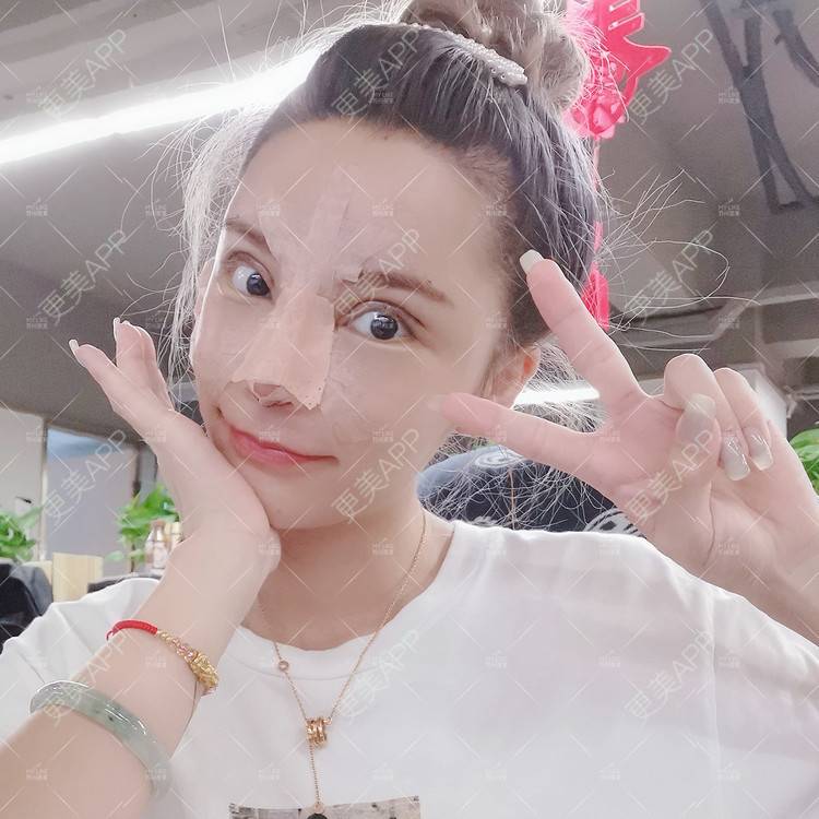 更美 - 土豆泥泥泥的双眼皮经验 | 自体脂肪面部填充 | 眼部多项 | 鼻部多项 | 苏州 | 隆鼻 | 双眼皮