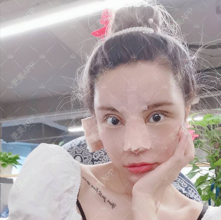 更美 - 土豆泥泥泥的双眼皮经验 | 自体脂肪面部填充 | 眼部多项 | 鼻部多项 | 苏州 | 隆鼻 | 双眼皮
