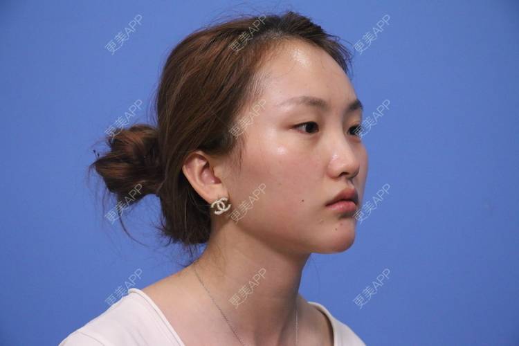 更美 - 琪琪格布的颧骨内推经验 | 颧骨内推 | 颧骨提高 | 颧弓降低 | 颧骨填充 | 下颌角切除 | 下巴截骨