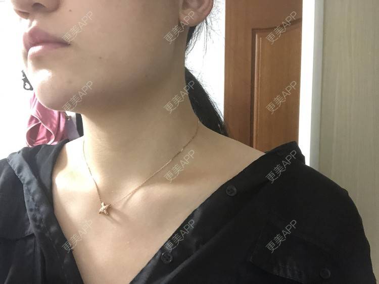 更美 - 阿发4.1的注射塑形腿部经验 | 注射塑形腿部 | 上海