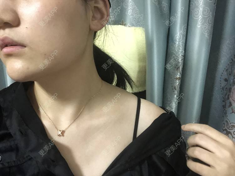 更美 - 阿发4.1的注射塑形腿部经验 | 注射塑形腿部 | 上海