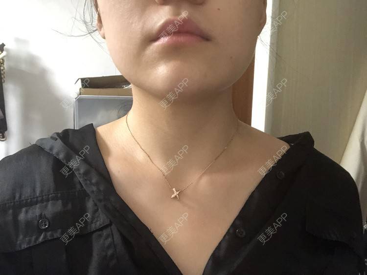 更美 - 阿发4.1的注射塑形腿部经验 | 注射塑形腿部 | 上海