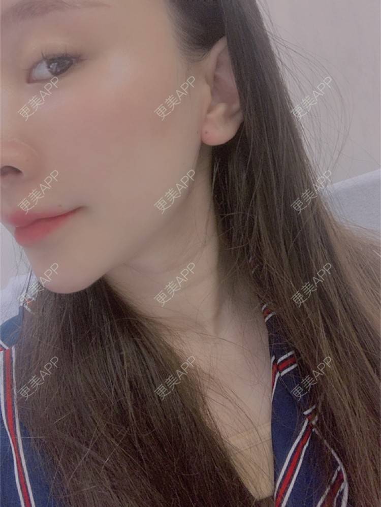 更美 - 小叮当king的除皱瘦脸经验 | 除皱瘦脸 | 重庆