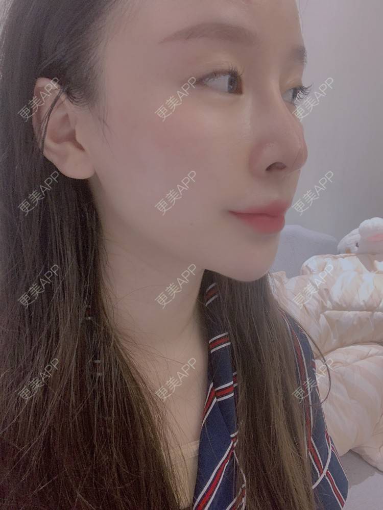 更美 - 小叮当king的除皱瘦脸经验 | 除皱瘦脸 | 重庆