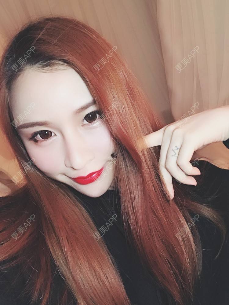 更美 - 小叮当king的玻尿酸面颊经验 | 重庆 | 玻尿酸面颊