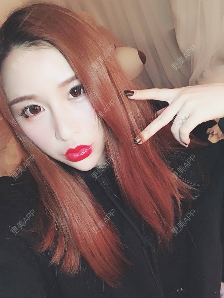 更美 - 小叮当king的玻尿酸面颊经验 | 重庆 | 玻尿酸面颊