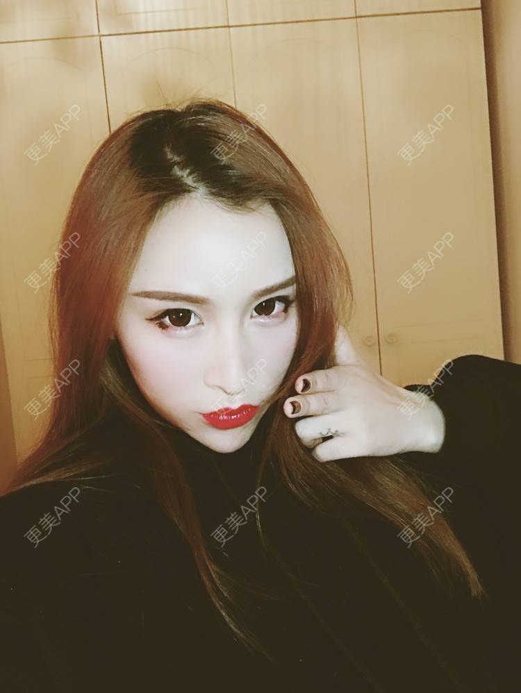 更美 - 小叮当king的玻尿酸面颊经验 | 重庆 | 玻尿酸面颊
