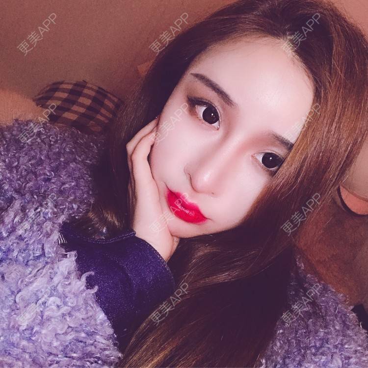 更美 - 小叮当king的玻尿酸面颊经验 | 重庆 | 玻尿酸面颊