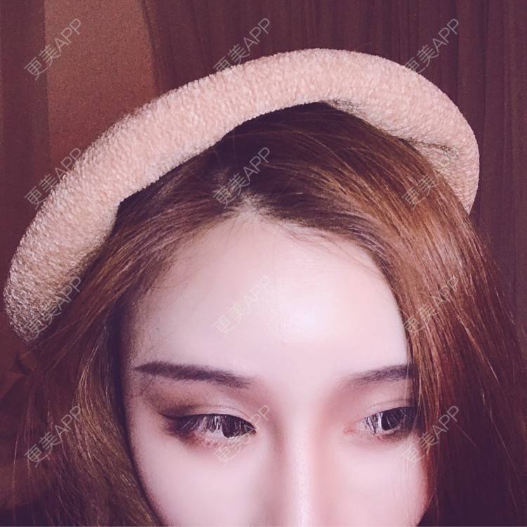 更美 - 小叮当king的玻尿酸面颊经验 | 重庆 | 玻尿酸面颊
