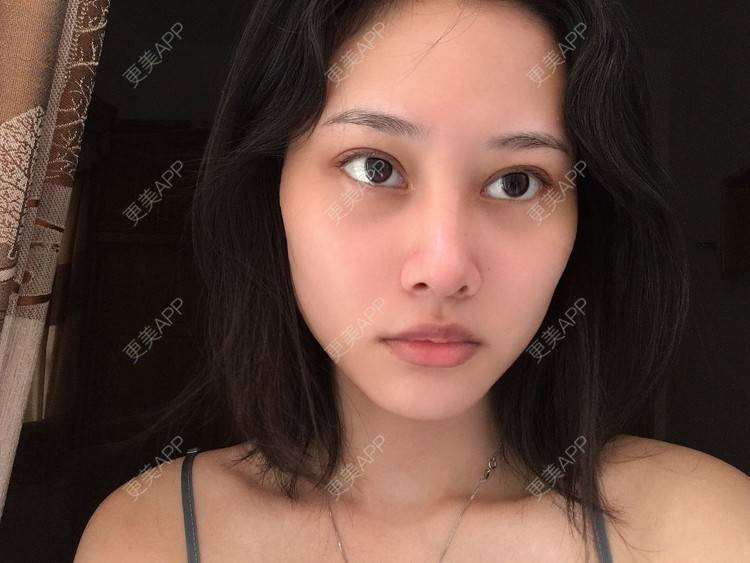 更美 - 更美用户zccwauimkc的肋软骨隆鼻日记 | 肋软骨隆鼻 | 舟山