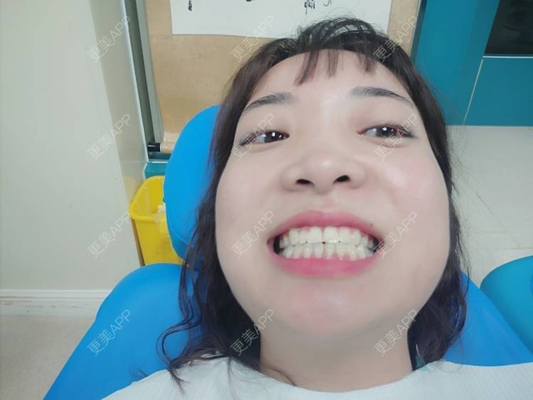 更美 - 橙子Jiang的牙齿矫正经验 | 牙齿矫正 | 成都