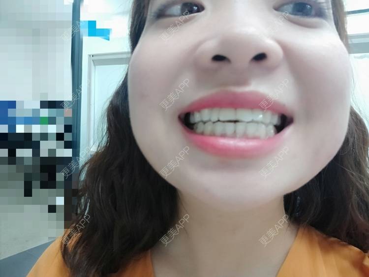 更美 - 橙子Jiang的牙齿矫正经验 | 牙齿矫正 | 成都