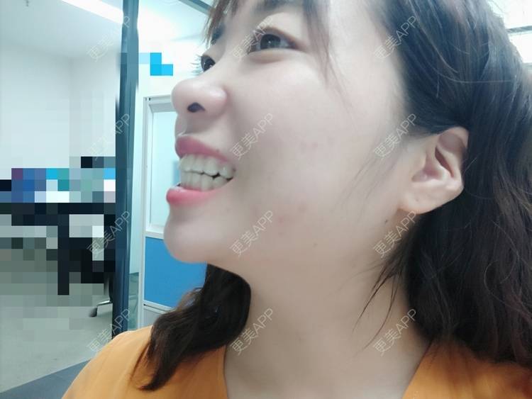更美 - 橙子Jiang的牙齿矫正经验 | 牙齿矫正 | 成都
