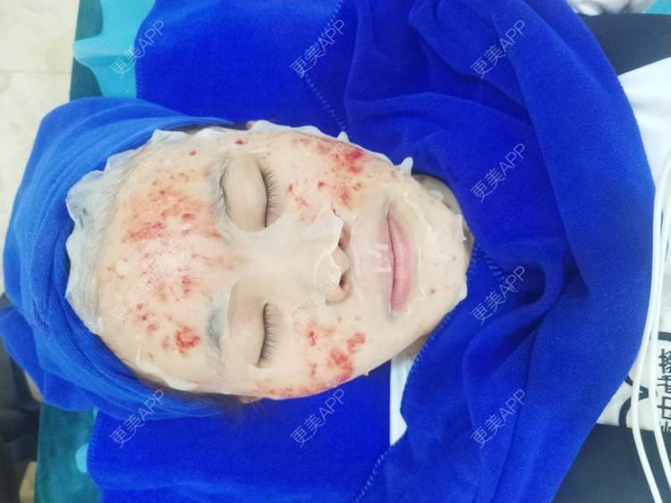 更美 - 鴘鴿的水光项目经验 | 东莞 | 水光项目