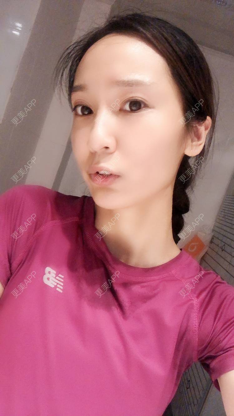 更美 - 时代新青年的经验 | 杭州 | 自体脂肪全面部填充 | 自体脂肪全面填充 | 视频日记