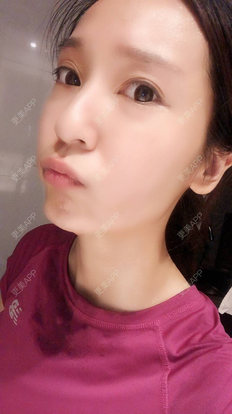 更美 - 时代新青年的经验 | 杭州 | 自体脂肪全面部填充 | 自体脂肪全面填充 | 视频日记